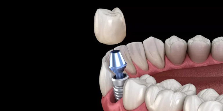 How Much Do Dental Implants Cost in Surprise, AZ? What You Need to Know Before You Decide 